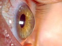 keratoconic eye