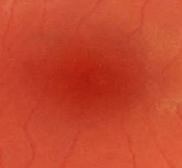macular region with subtle pigmentary changes
