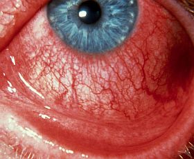 red_eye_assessments1