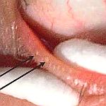 MG-expression